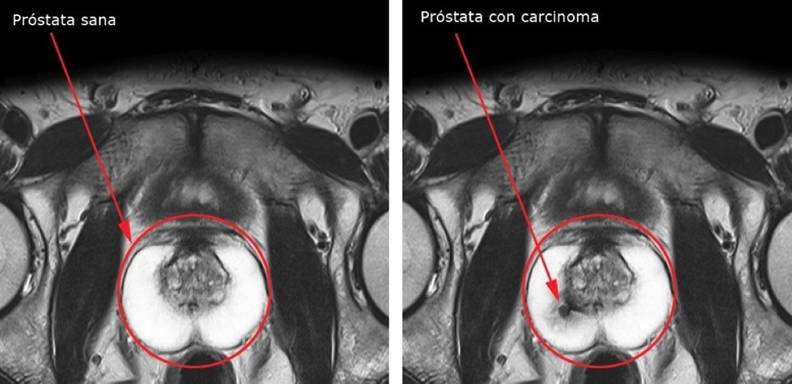 Se trata de nuevos parámetros de imagenología clínica con mayor exactitud en la detección y tratamiento del primer tipo de patología cancerígena que afecta a los hombres en Venezuela