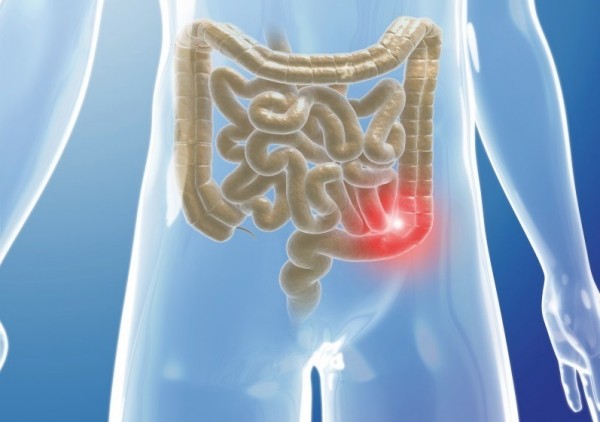 “Alrededor de los 40 años el cuerpo puede empezar a producir pólipos, que son crecimientos anormales en la capa interior o mucosa del intestino grueso. A estos pólipos les toma unos 10 o 15 años convertirse en cáncer colorrectal”, precisó José di Giorgio, médico gastroenterólogo de la Clínica de Prevención del Cáncer de la SAV, quien agregó que si la persona tiene familiares de primer grado (hijos, hermanos o padres) que hayan padecido de cáncer colorrectal se debe efectuar el chequeo 10 años antes de la edad del diagnóstico del familiar. 